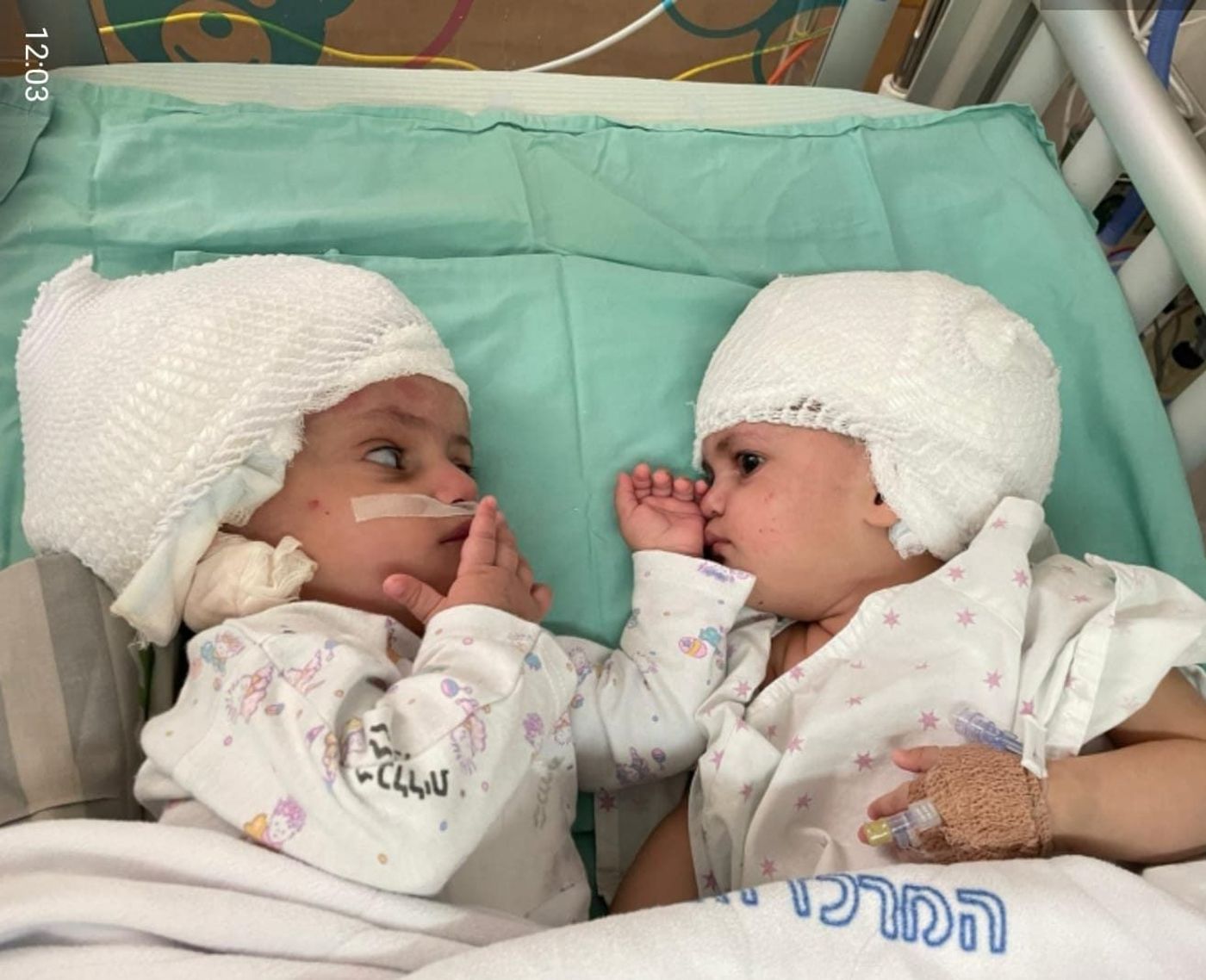 לראשונה בישראל, תאומות סיאמיות הופרדו בניתוח מורכב