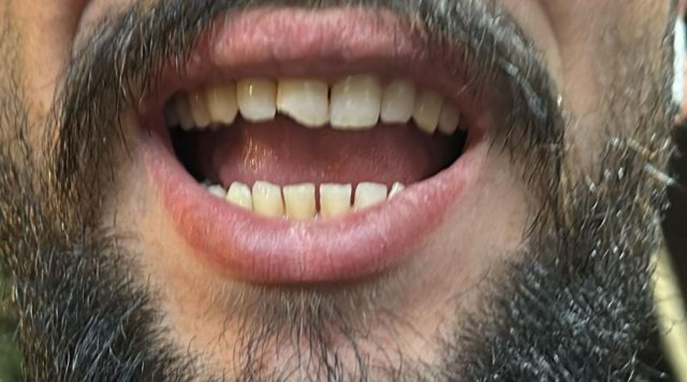 שוטר שנשברה לו שן (דוברת המשטרה)