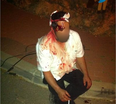 צפו: ישראלי נפצע קשה; הצבא מפנה דווקא את היהודים