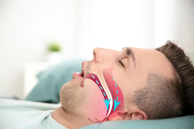 לא מדע בדיוני: הלייזר שיעזור לכם להפסיק לנחור