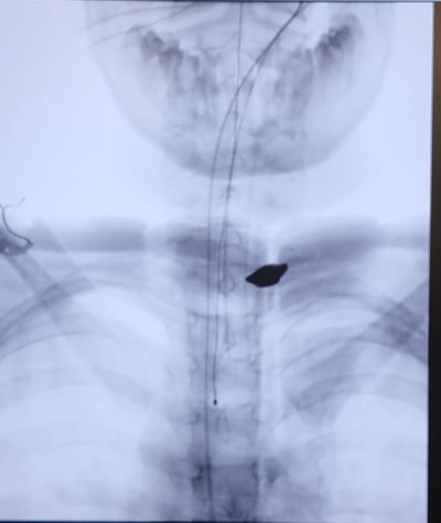 נס: רסיס של 18 מ"מ הוצא מגופו של ילד ממג'דל שמס